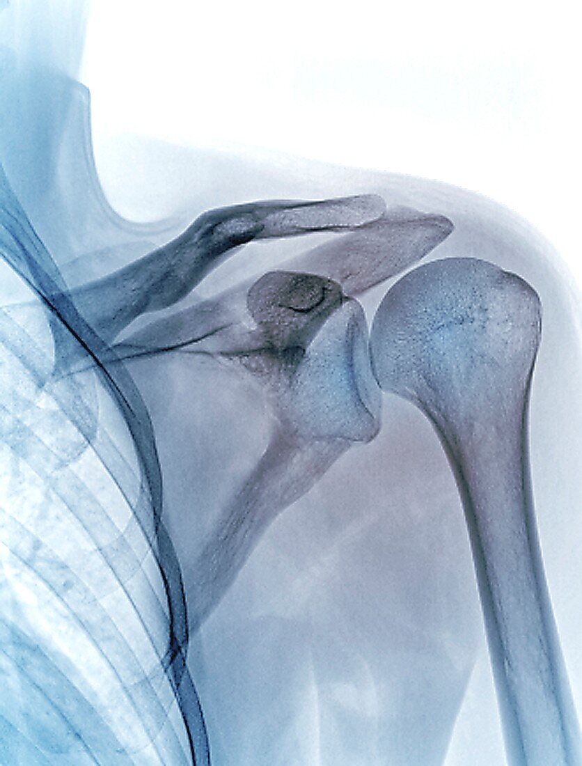 Shoulder joint, X-ray