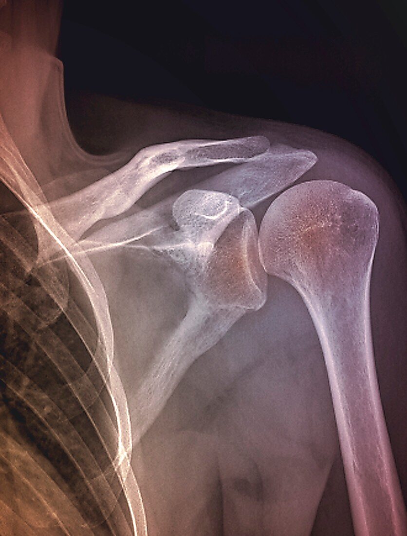 Shoulder joint, X-ray