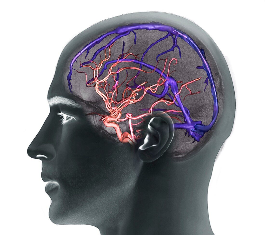 Brain arteries and venous sinuses, 3D CT angiogram