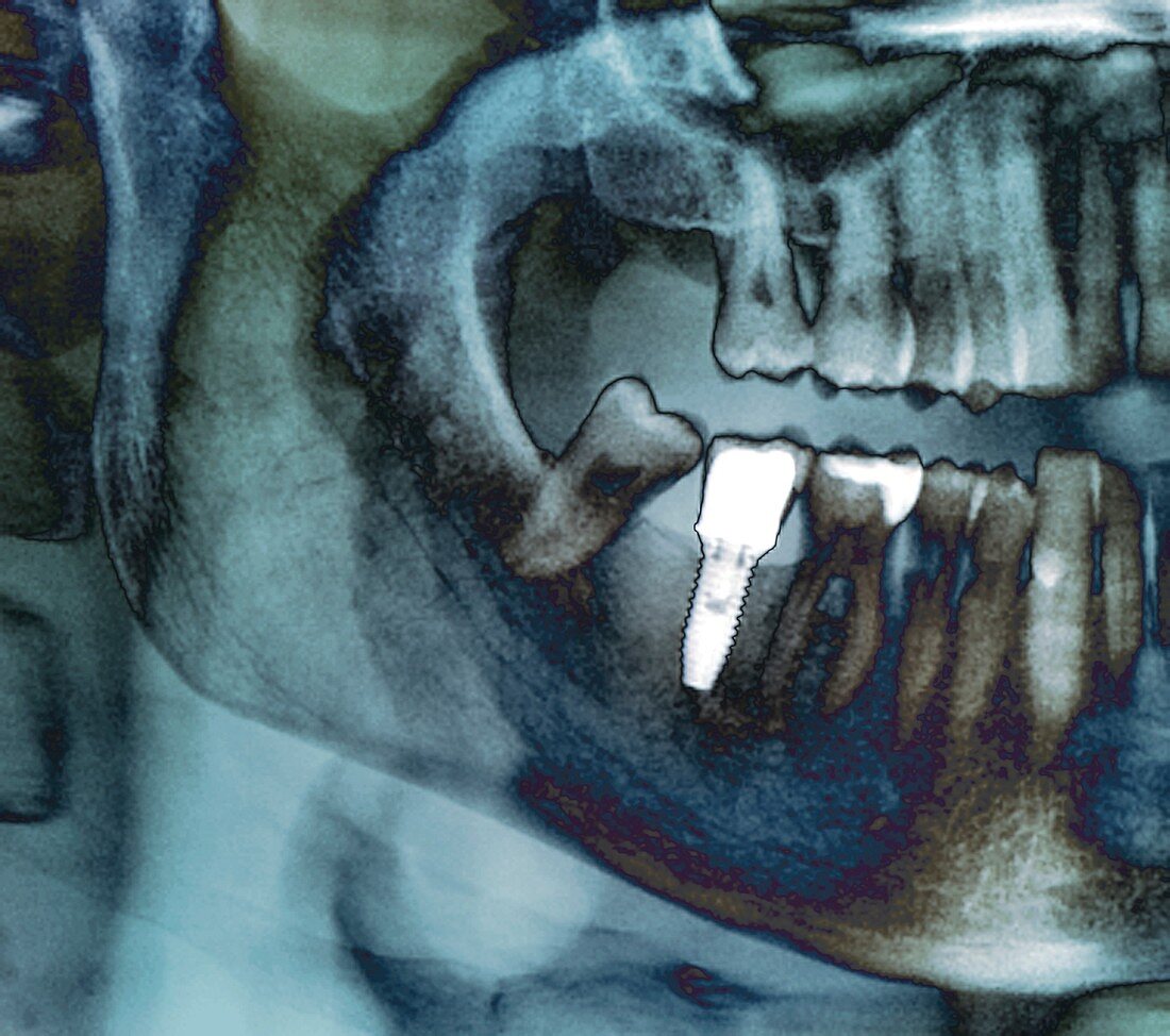 Dental implant, X-ray