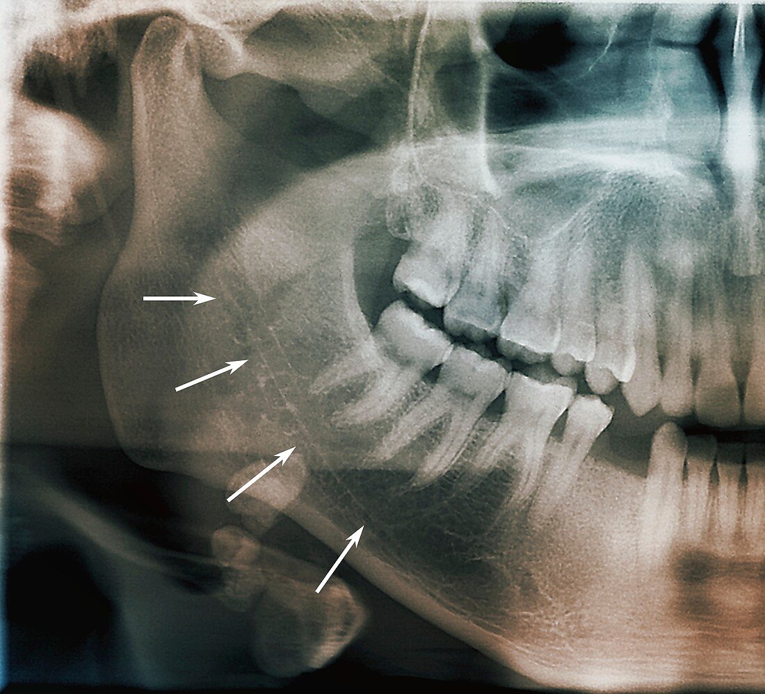 Mandibular canal and salivary gland stones, X-ray