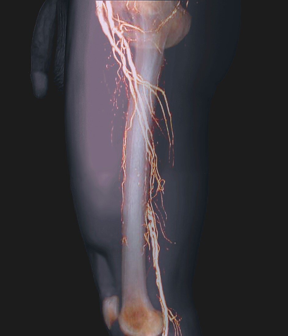 Nearly blocked femoral arteries, 3D CT angiogram