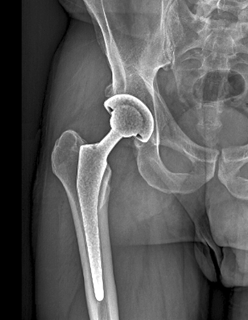 Total hip replacement, X-ray