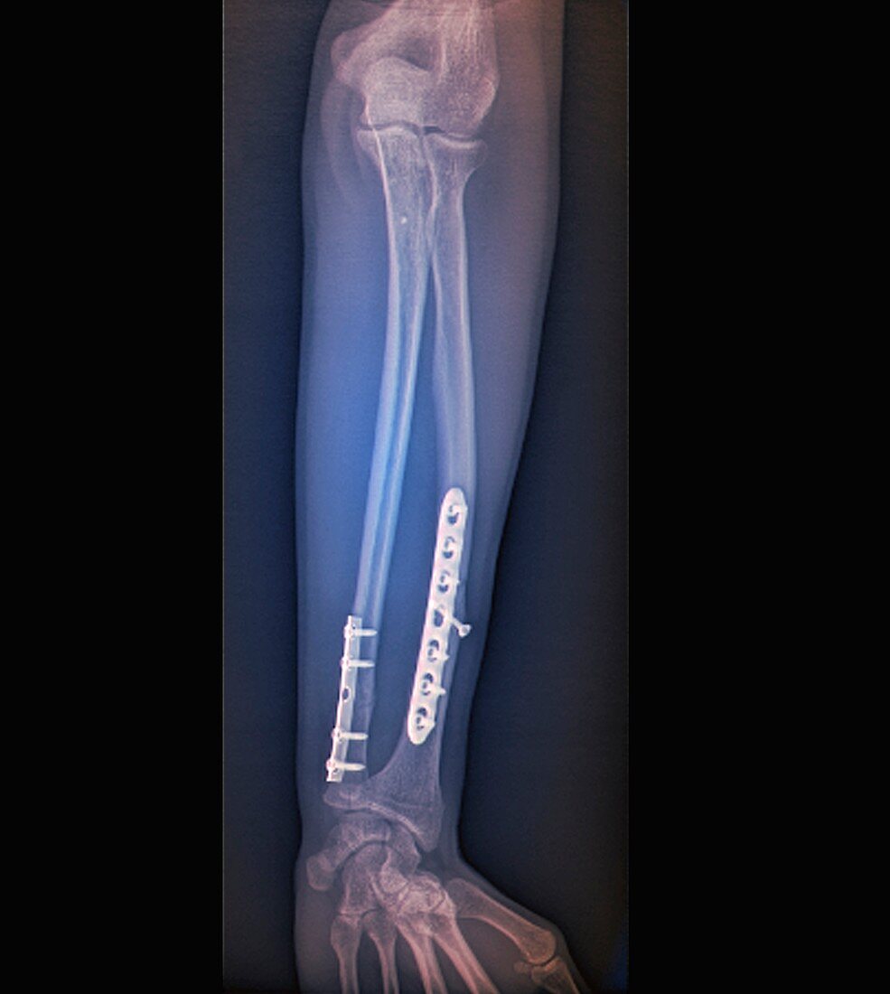 Pinned fractured lower arm bones, X-ray