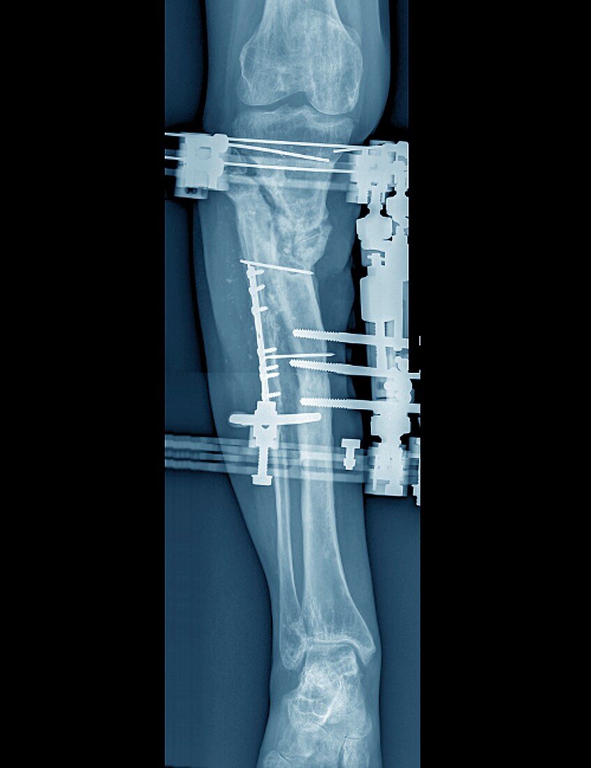 Pinned fractured lower leg bones, X-ray