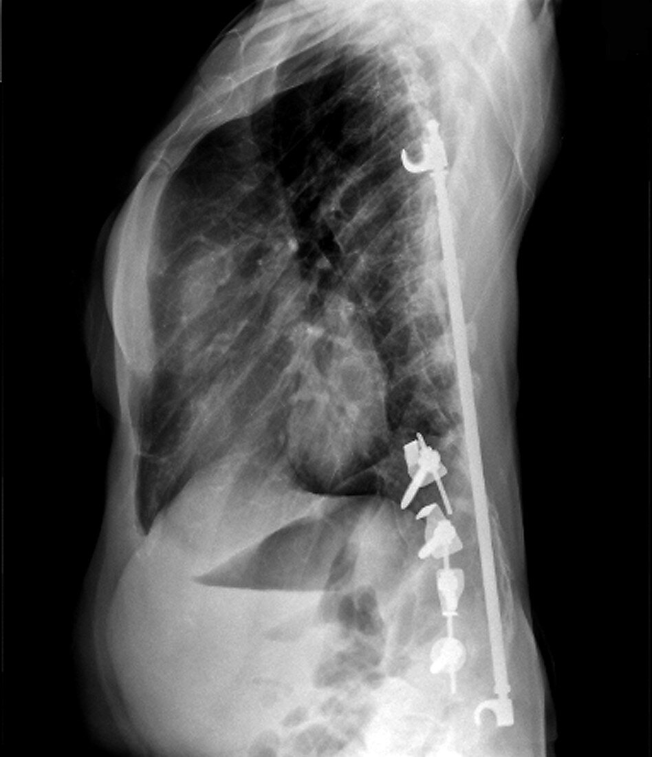 Harrington rod spinal implants in scoliosis, X-ray