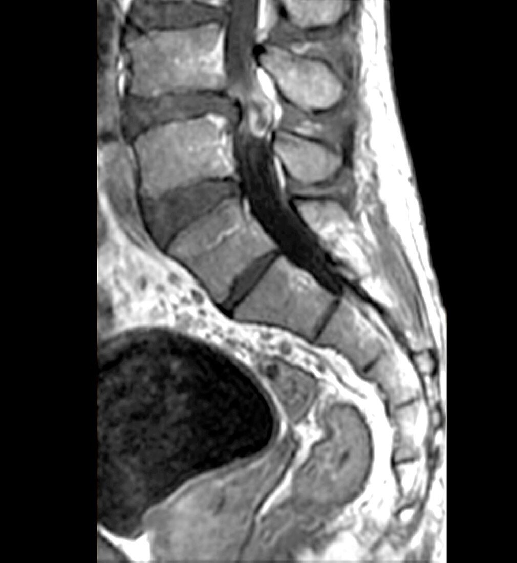 Slipped disc in the lumbar spine, MRI scan