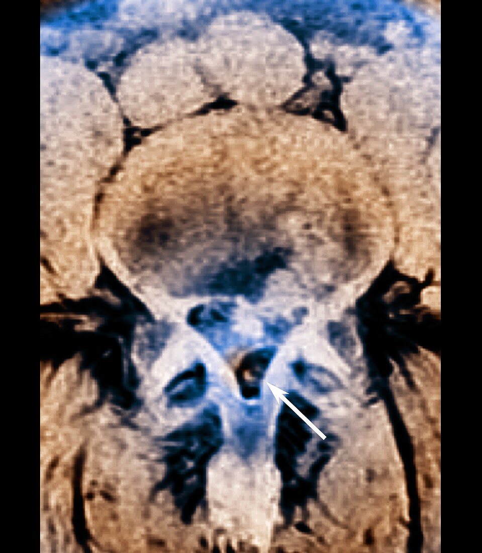 Slipped disc in the lumbar spine, MRI scan