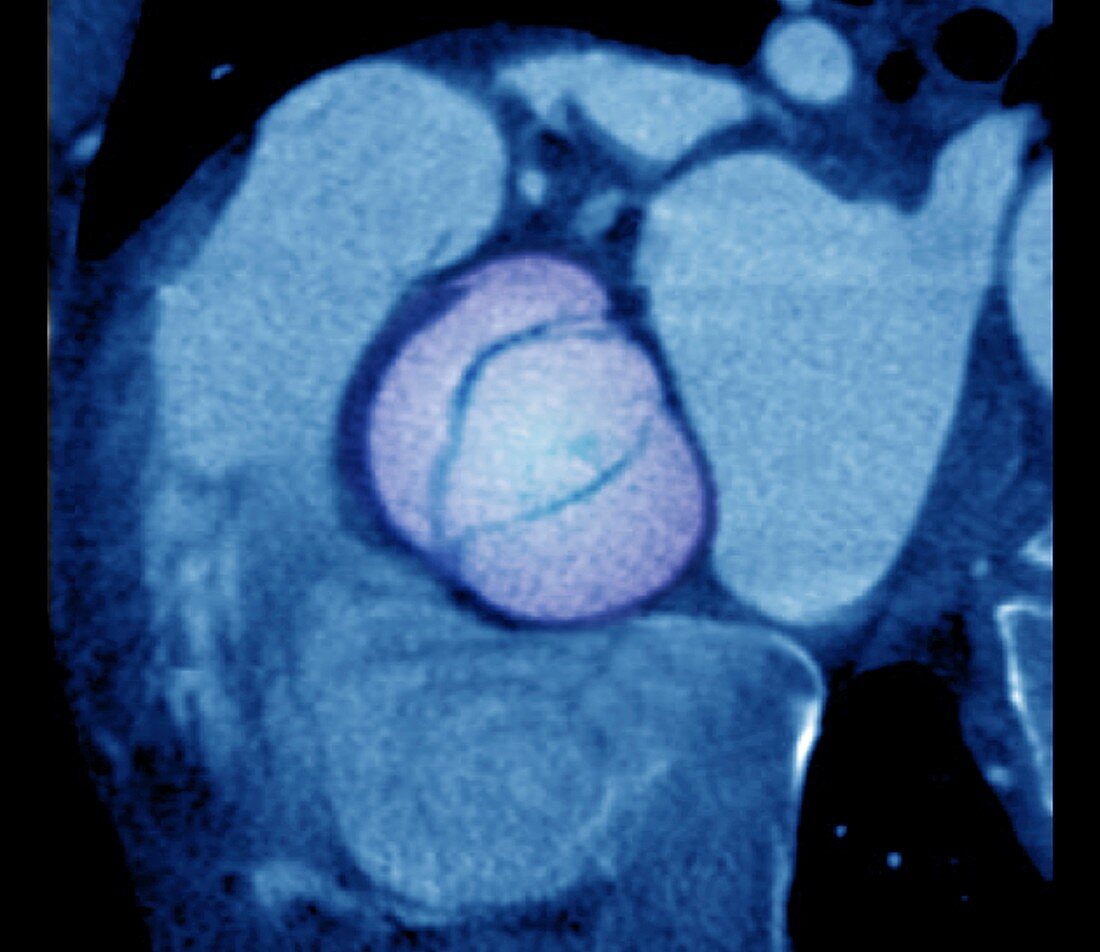 Aortic valve congenital deformity, CT scan