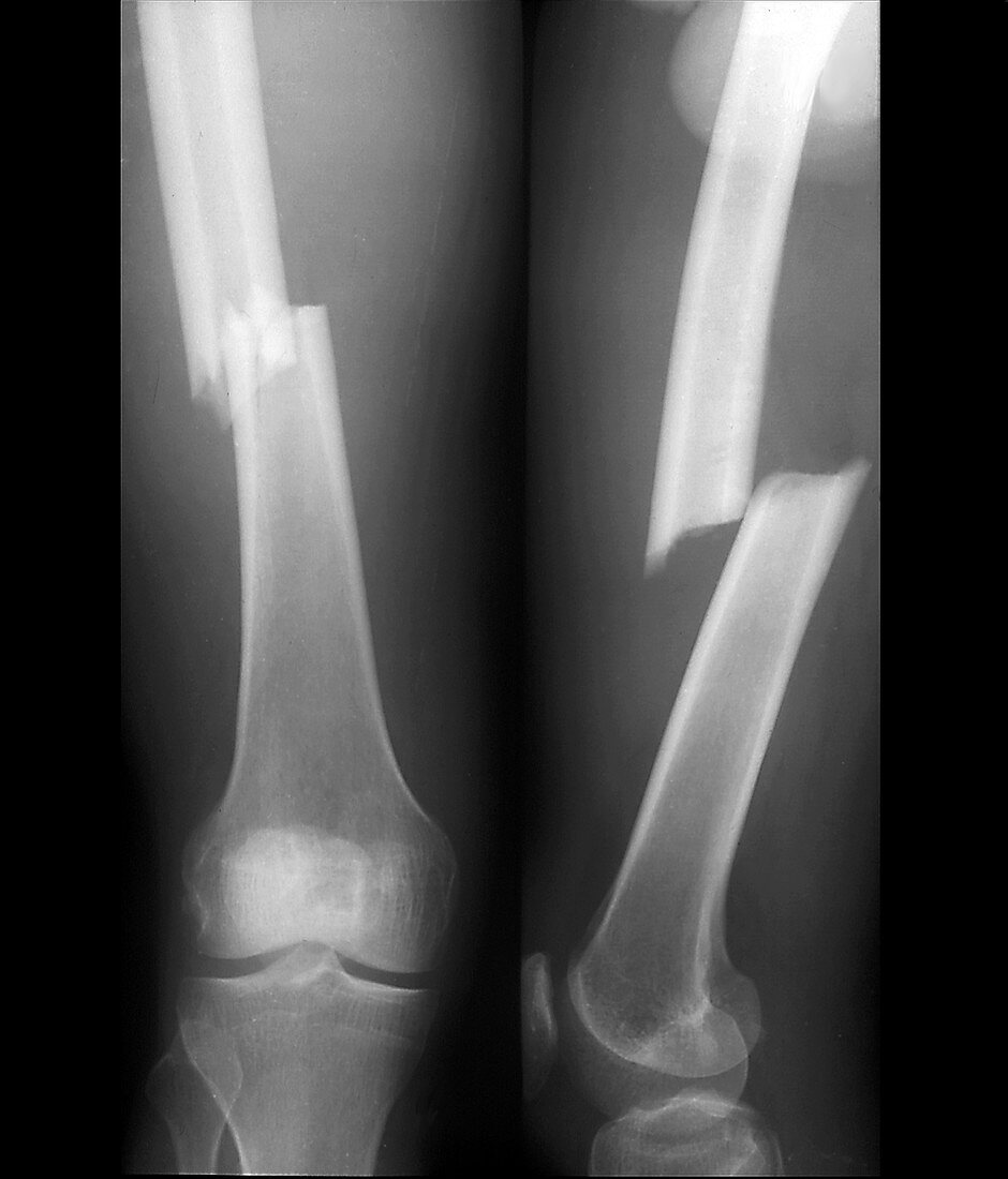 Fractured femoral shaft, X-rays