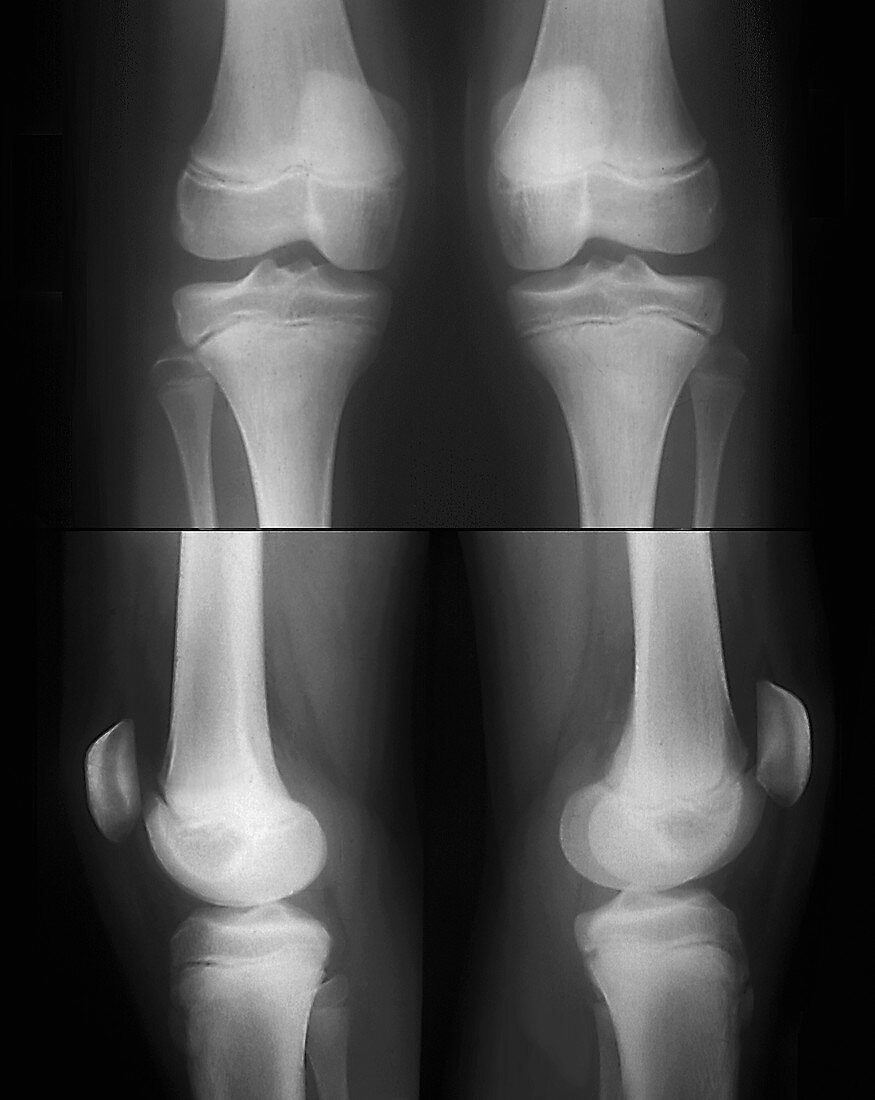 Teenage girl's knees, bilateral X-rays