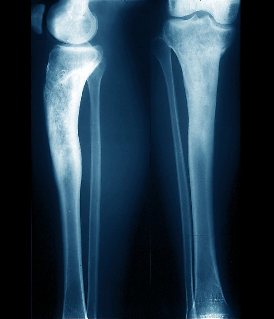 Osteomyelitis in the lower leg, X-rays