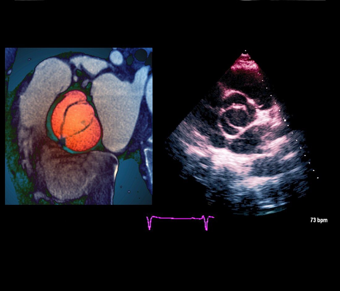 Aortic valve congenital deformity, CT and ultrasound scans