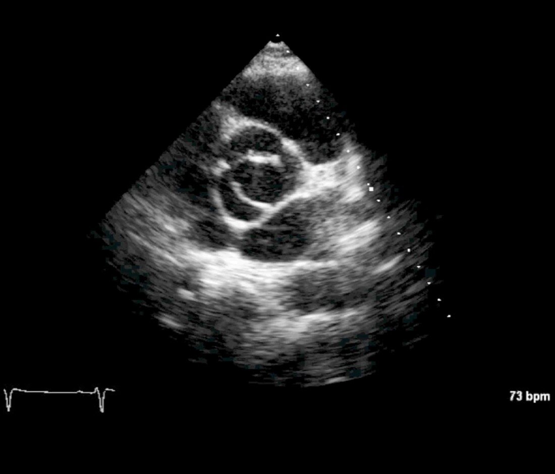 Aortic valve congenital deformity, cardiac ultrasound scan