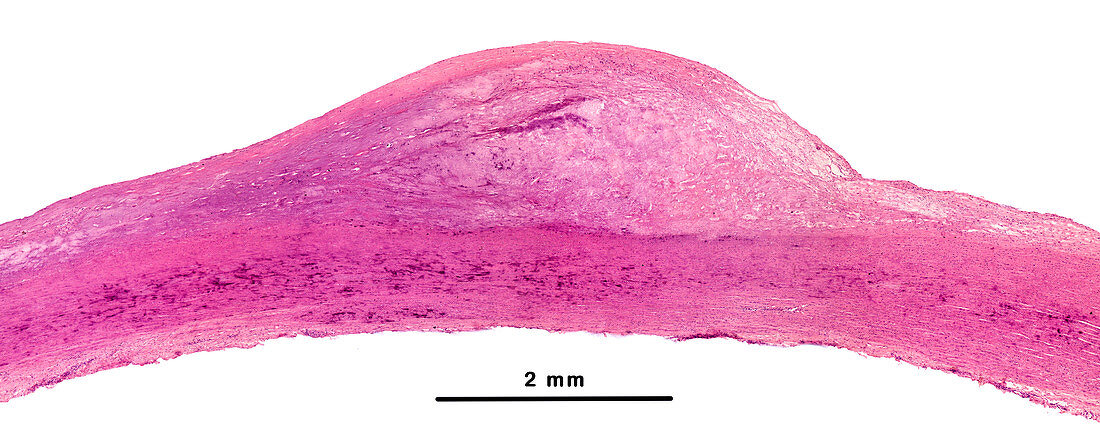 Atheroma plaque in aorta, light micrograph