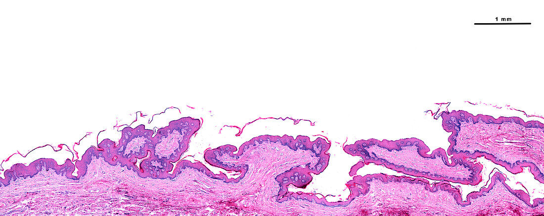 Foreskin genital warts, light micrograph