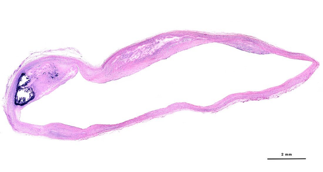 Atheroma plaques in coronary artery, light micrograph