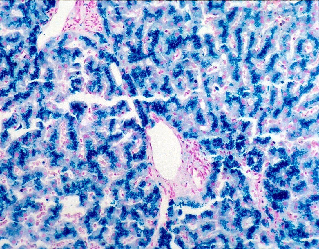 Hereditary hemochromatosis, light micrograph