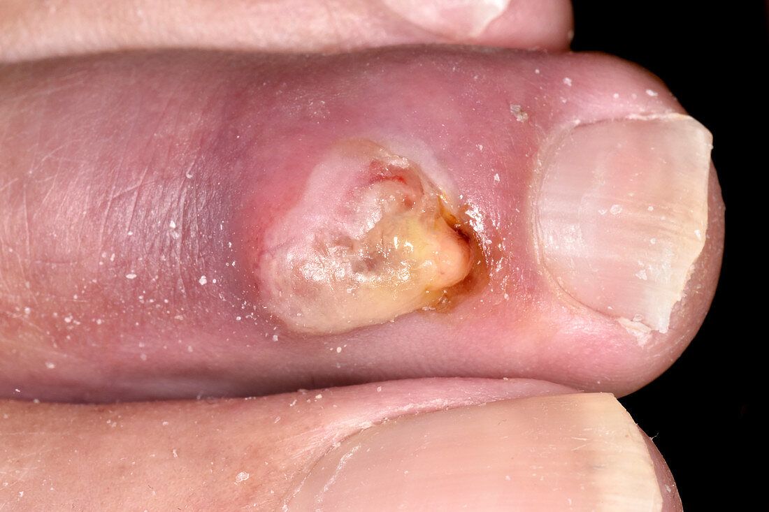 Infected toe cyst