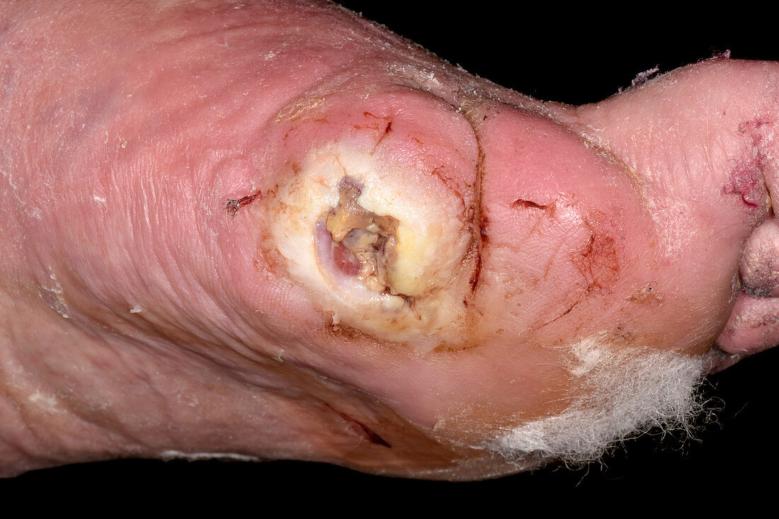 Infected amputated toe