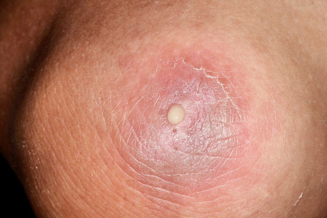 Infected olecranon bursitis