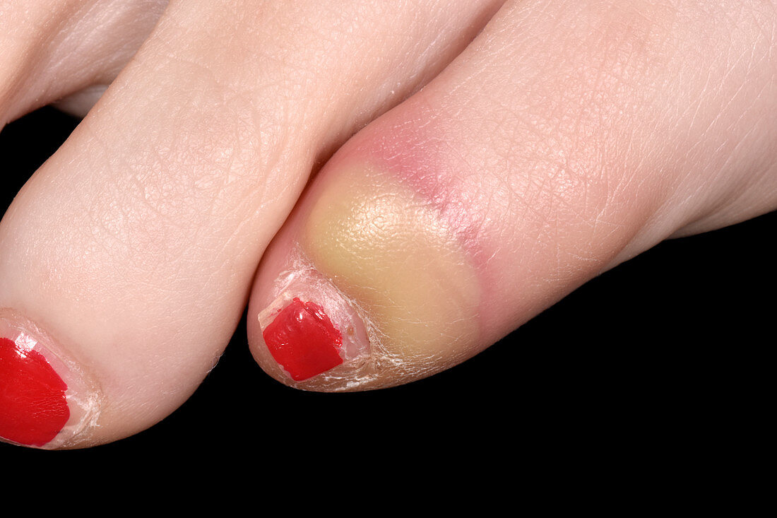 Infected toe