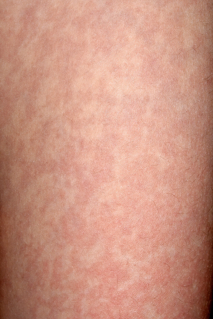 Hives in viral infection