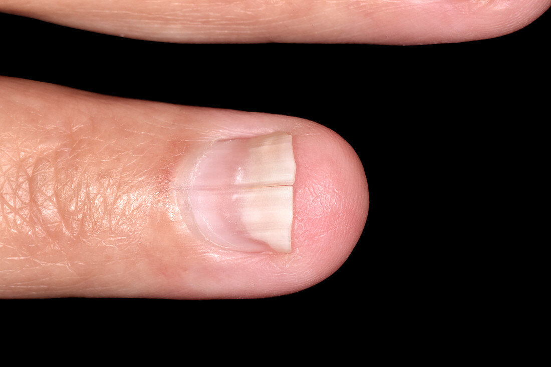 Split nail