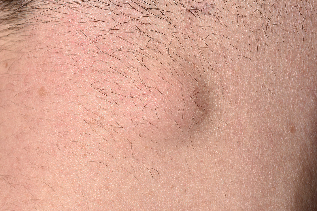 Sebaceous cyst on back of neck