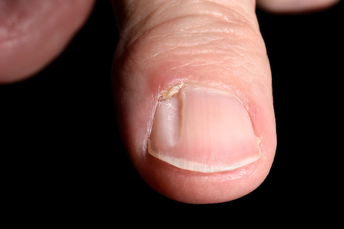 Grooved nail with mucous cyst