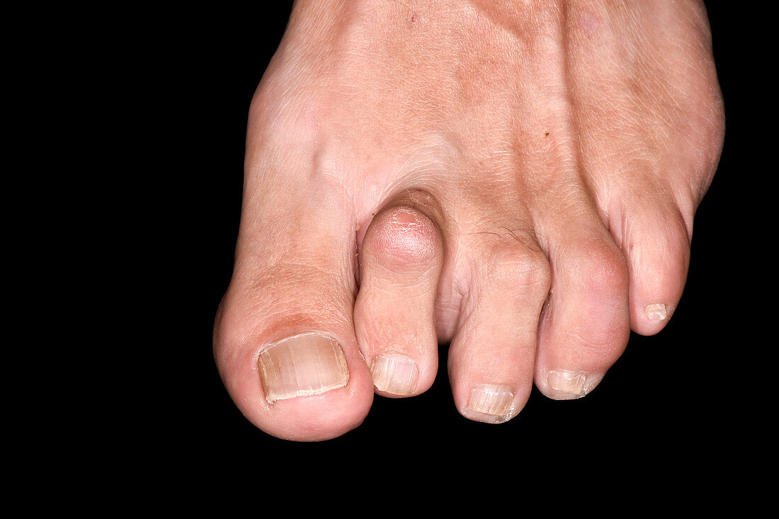 Hammer toe