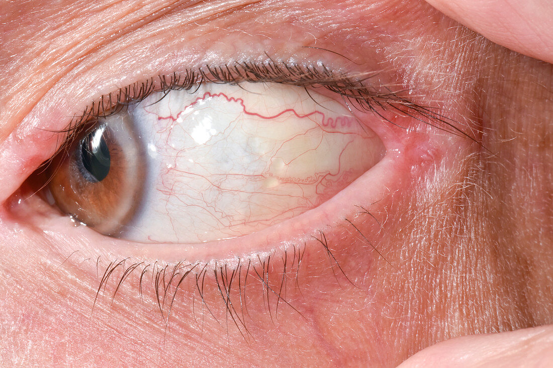 Conjunctival retention cysts