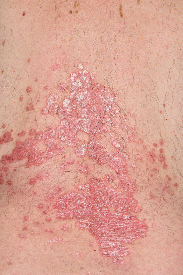 Plaque psoriasis