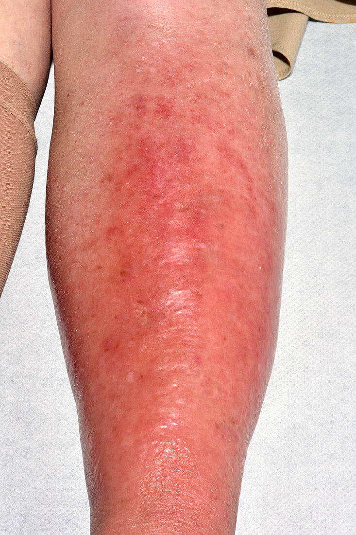 Cellulitis of the leg