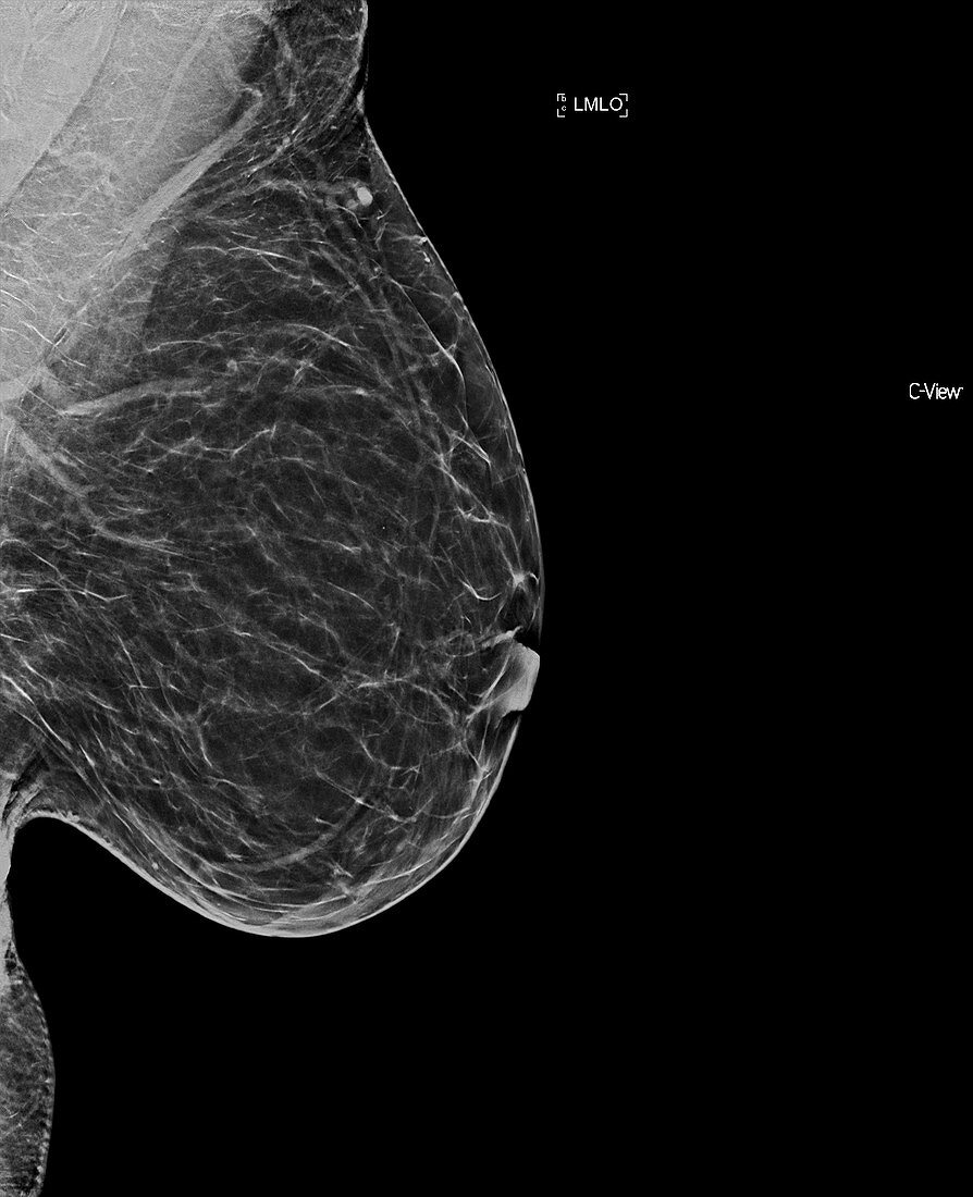 Normal breast, X-ray