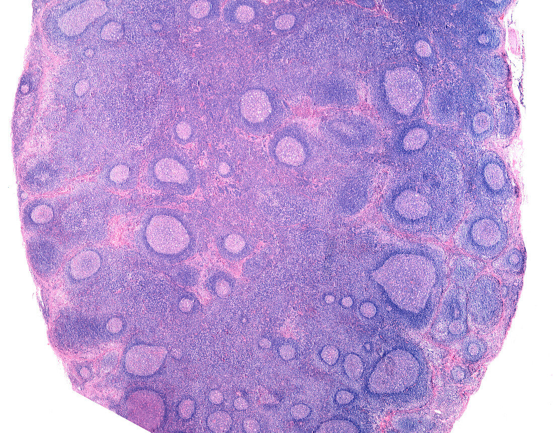 Chronic lymphadenitis, light micrograph