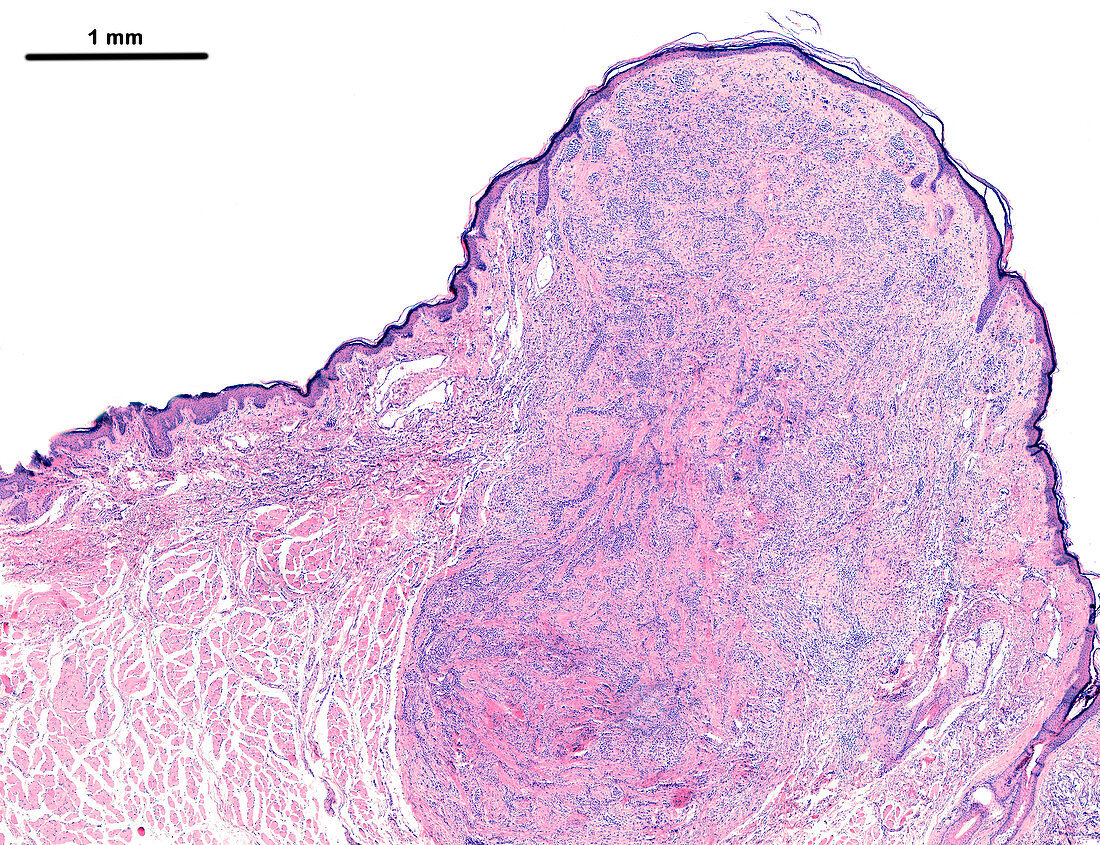 Melanocytic nevus on lip, light micrograph