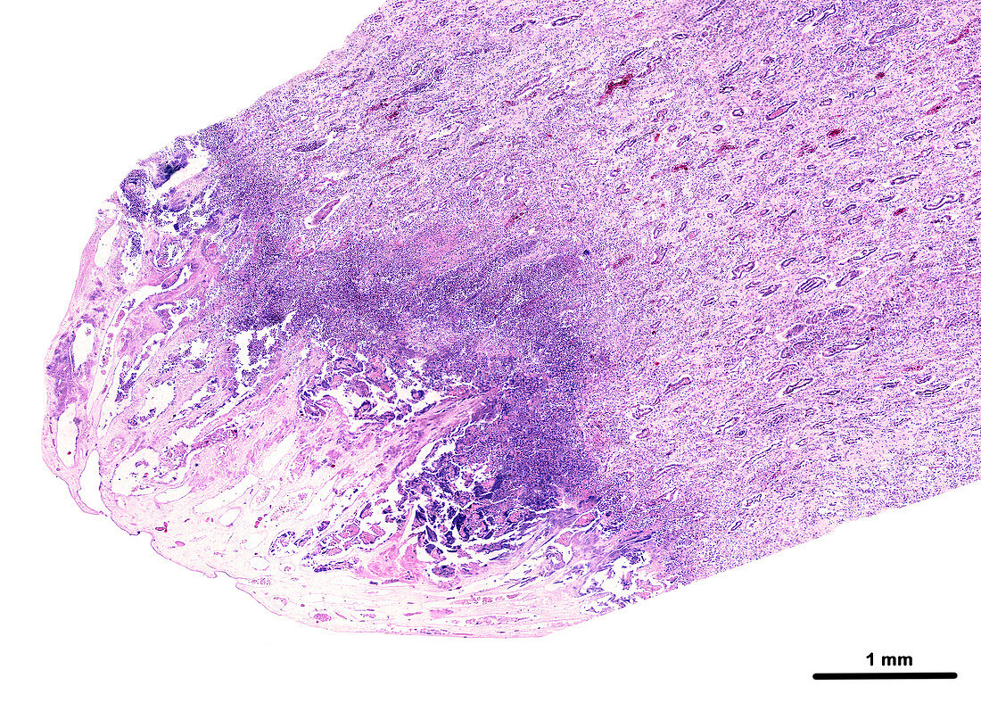 Papillary necrosis of human kidney, light micrograph