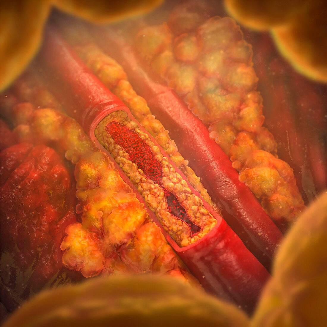 Atherosclerosis in an artery, illustration