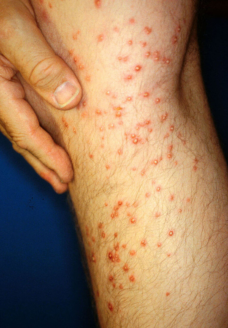 Fire Ant Bites