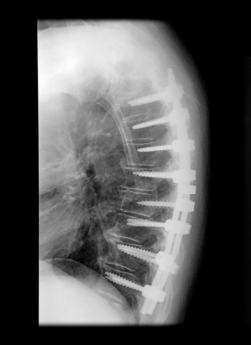Lateral X-ray Thoracic Spinal Instrumentation