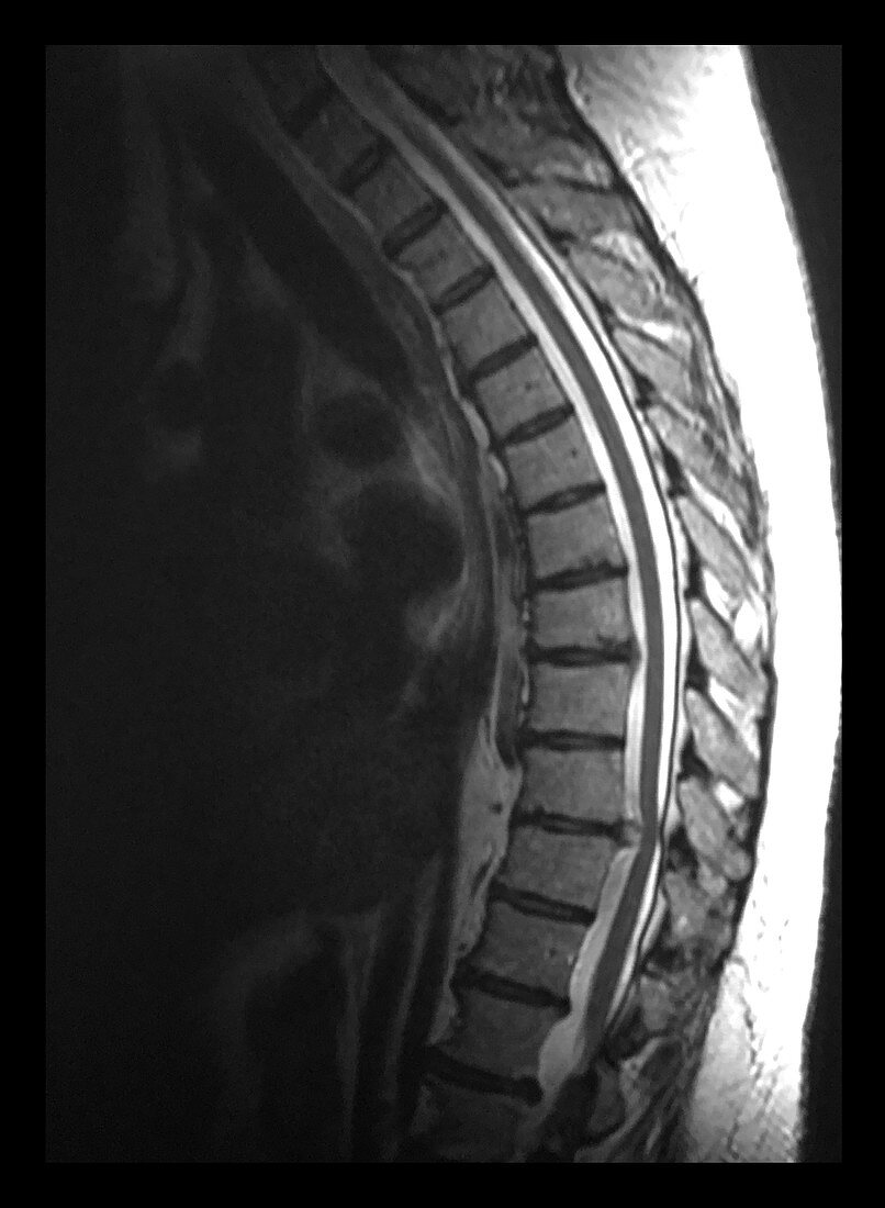 MRI Thoracic Disc Herniation