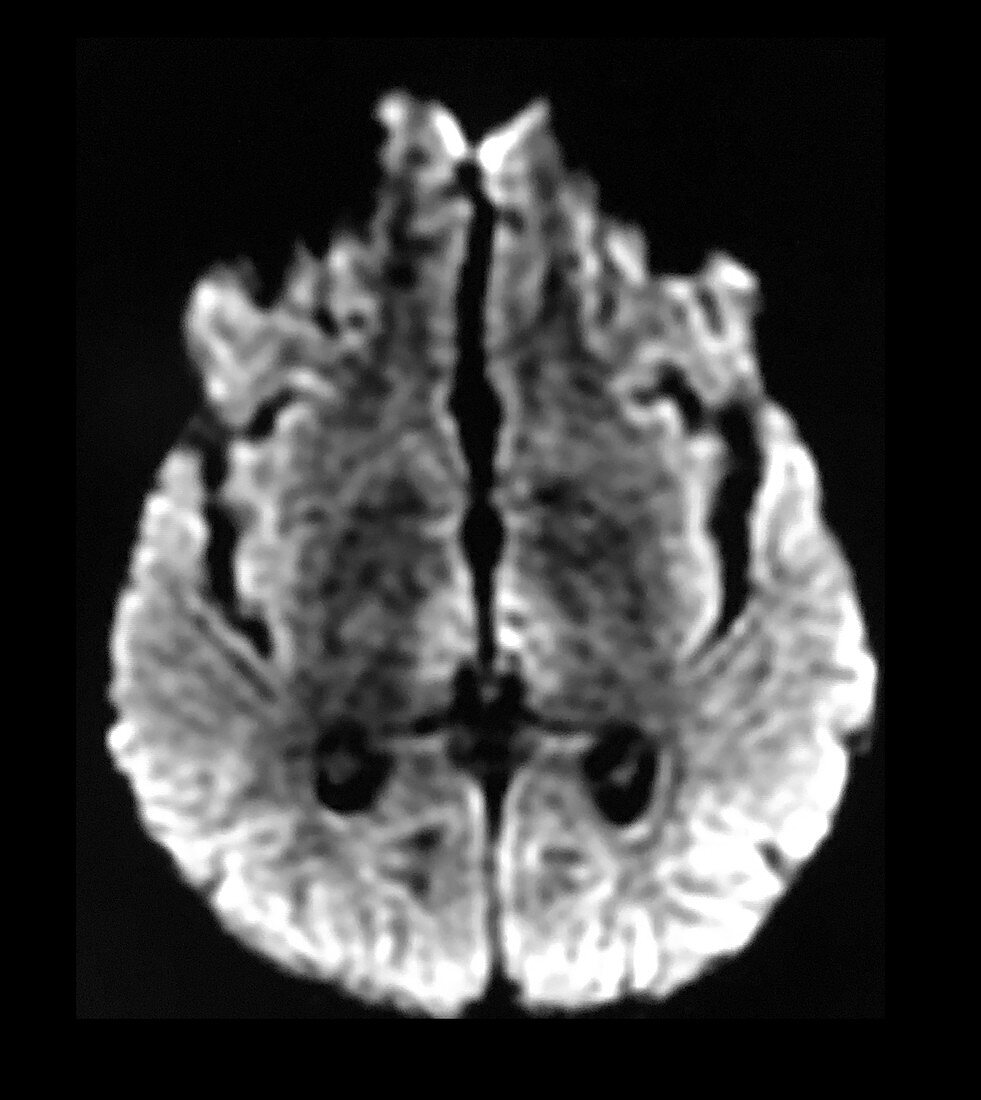 Wernicke's Encephalopathy on MRI