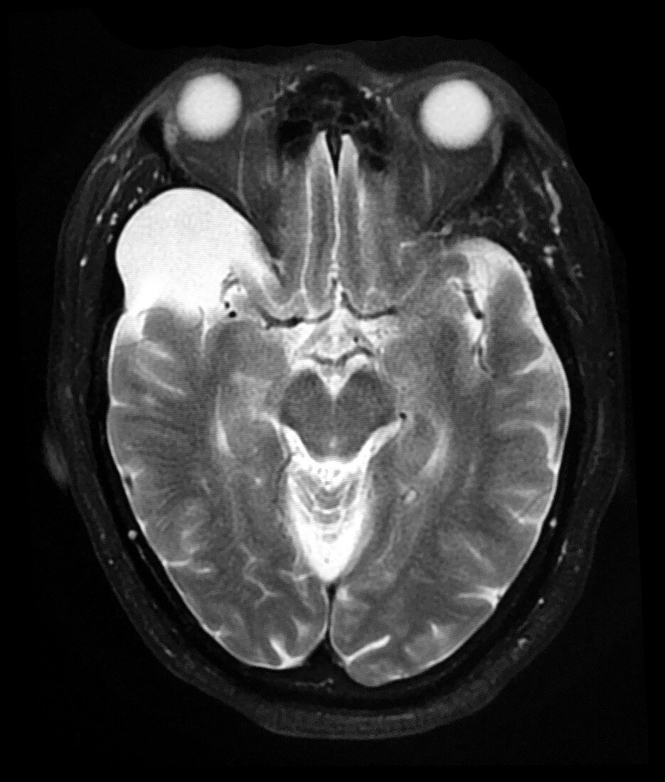 MRI of Arachnoid Cyst