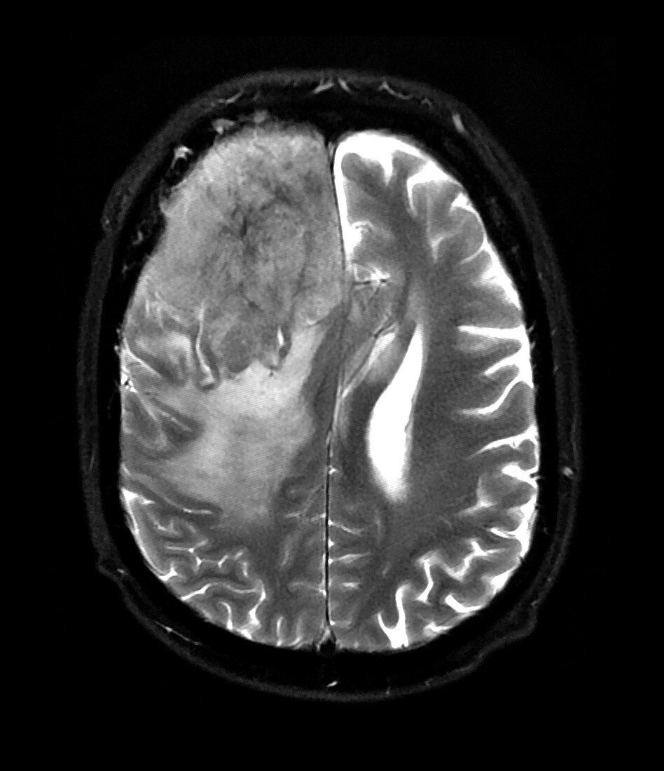 MRI of Invasive Meningioma