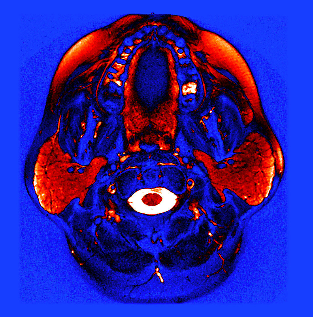 Enhanced Normal MRI Parotid Glands
