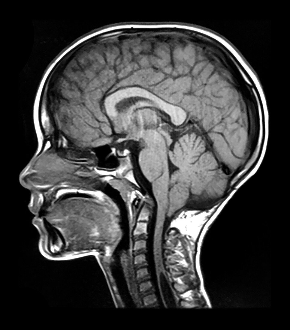 MRI Chiari I and Spinal Cord Syrinx