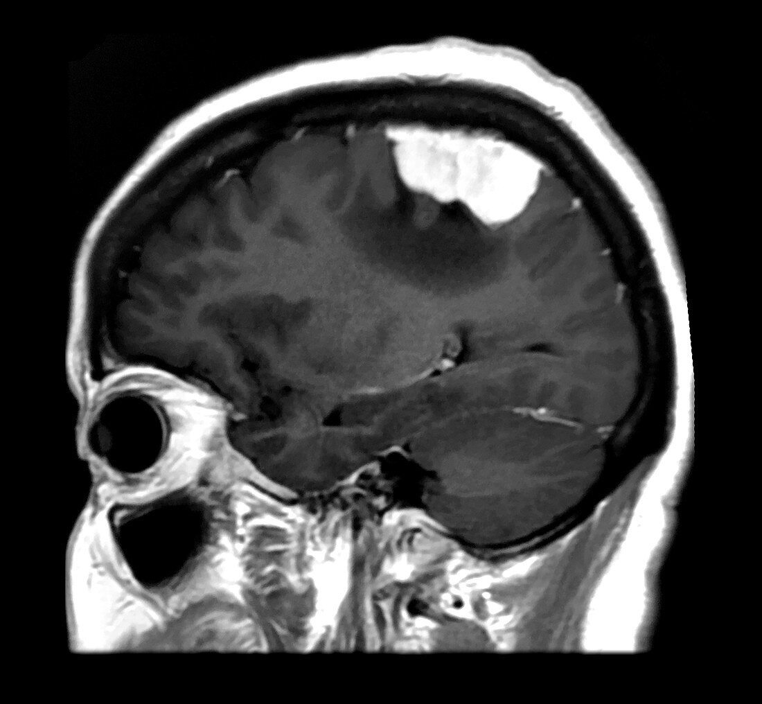 Vertex Meningioma MRI