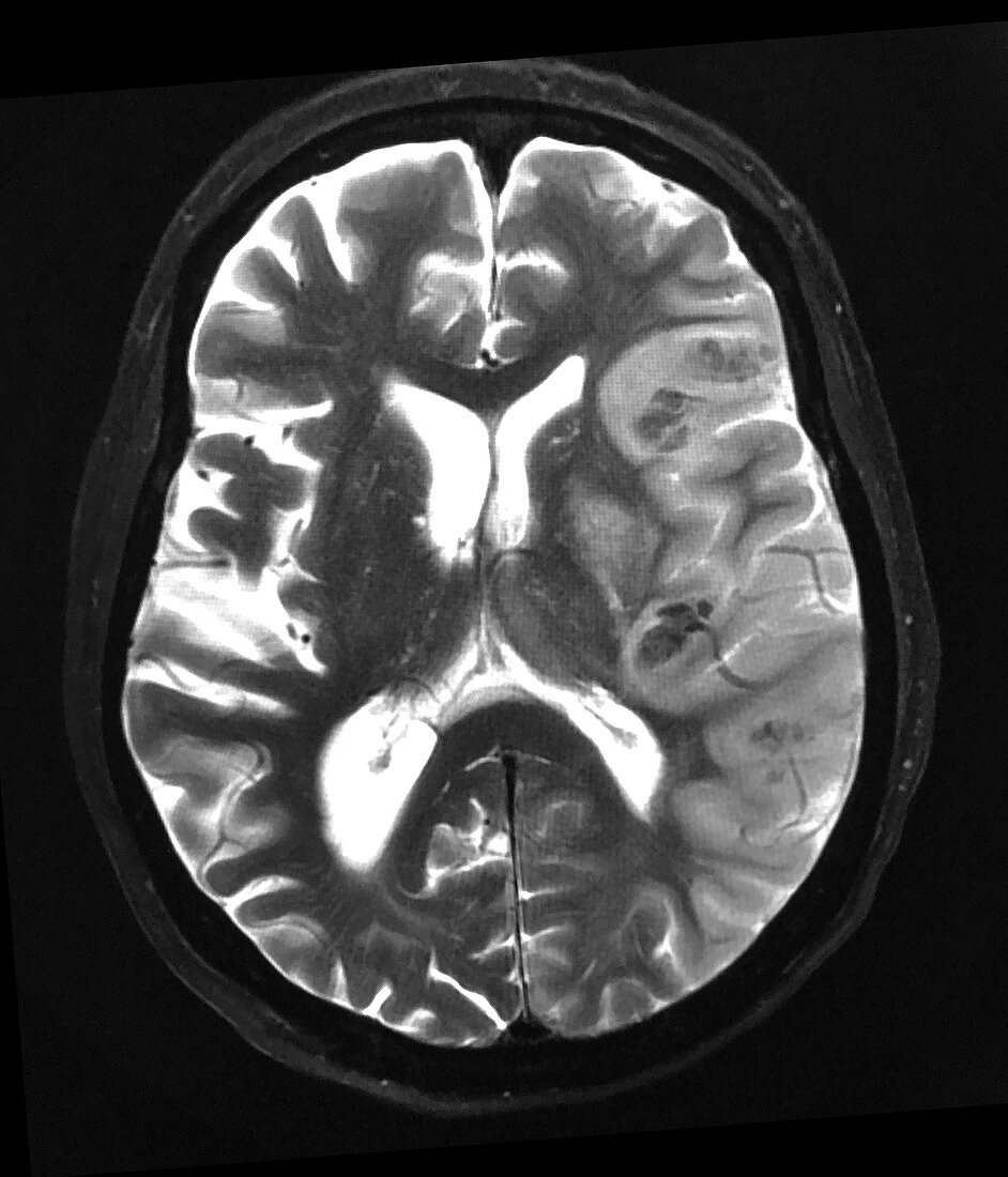 Haemorrhagic MCA Infarct MRI