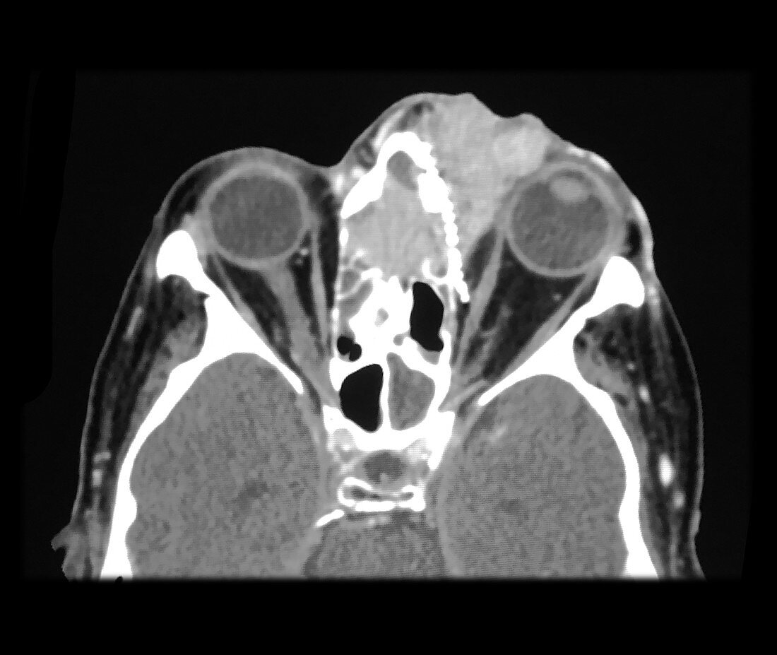 CT Squamous Cell Carcinoma, Head and Neck